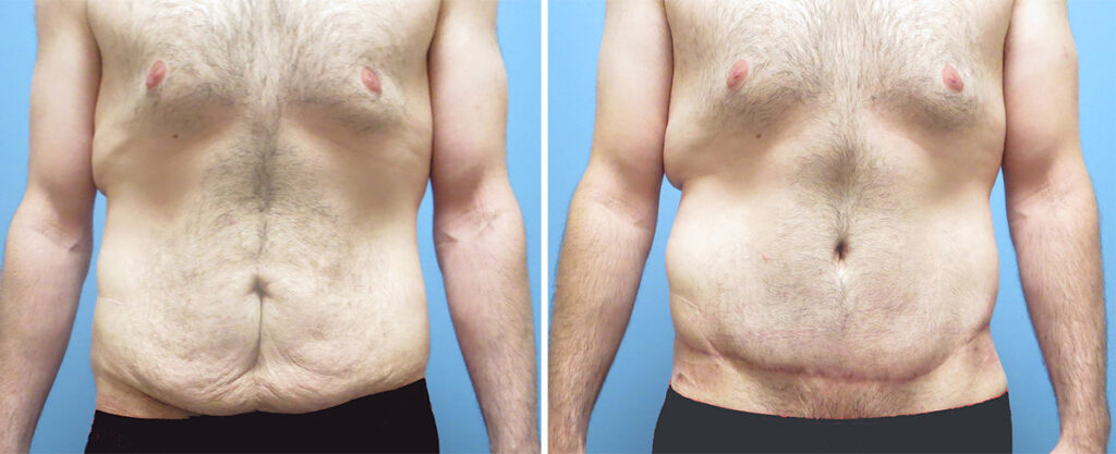 Tummy Tuck For Men Vancouver BC