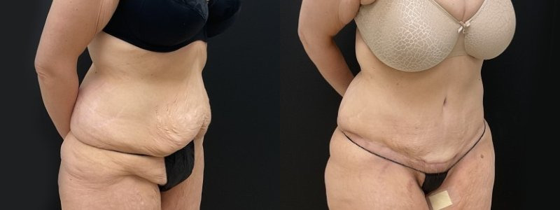 Abdominoplasty / Tummy Tuck Before and After Photos Vancouver
